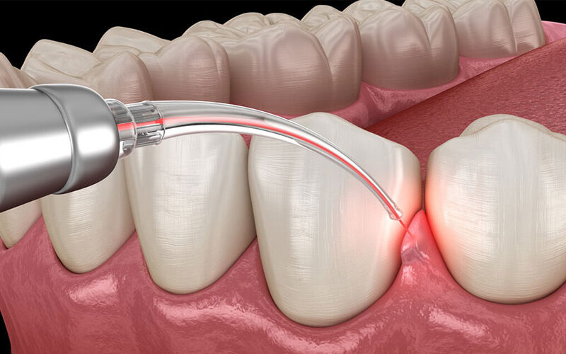 Laser Dentistry