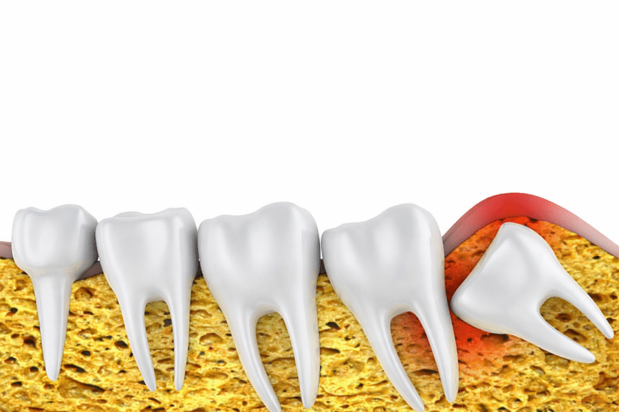 Wisdom Teeth: When to Remove and What to Expect