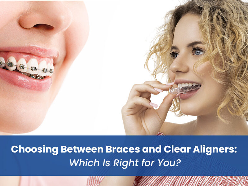 Choosing Between Braces and Clear Aligners: Which Is Right for You?