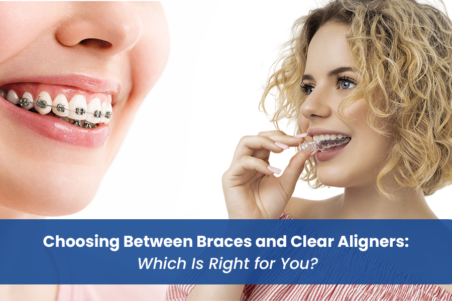Choosing Between Braces and Clear Aligners: Which Is Right for You?